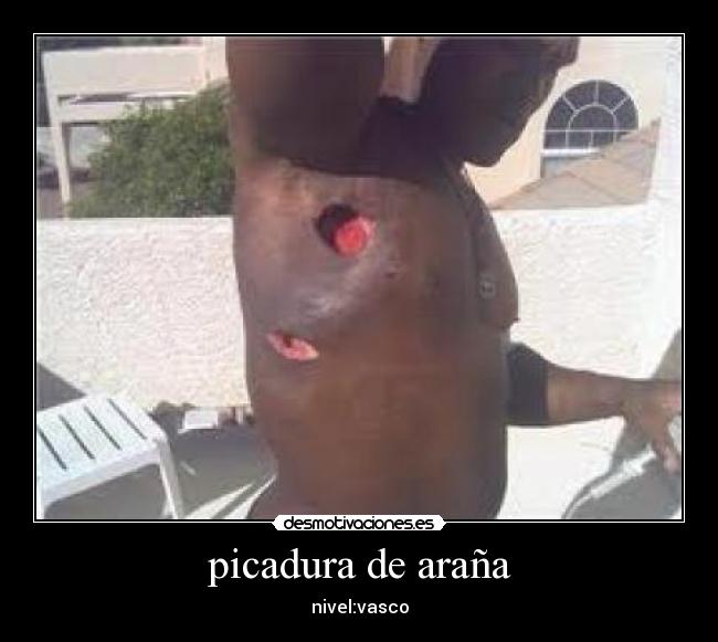 picadura de araña -