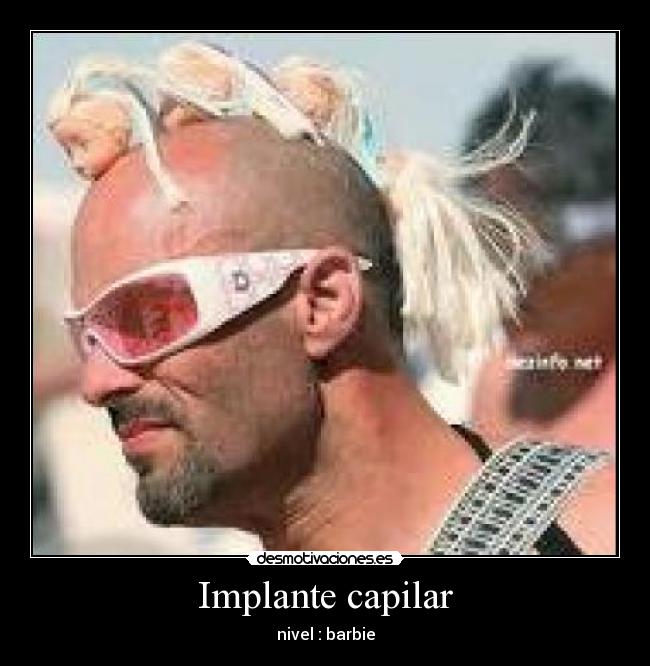 Implante capilar - nivel : barbie