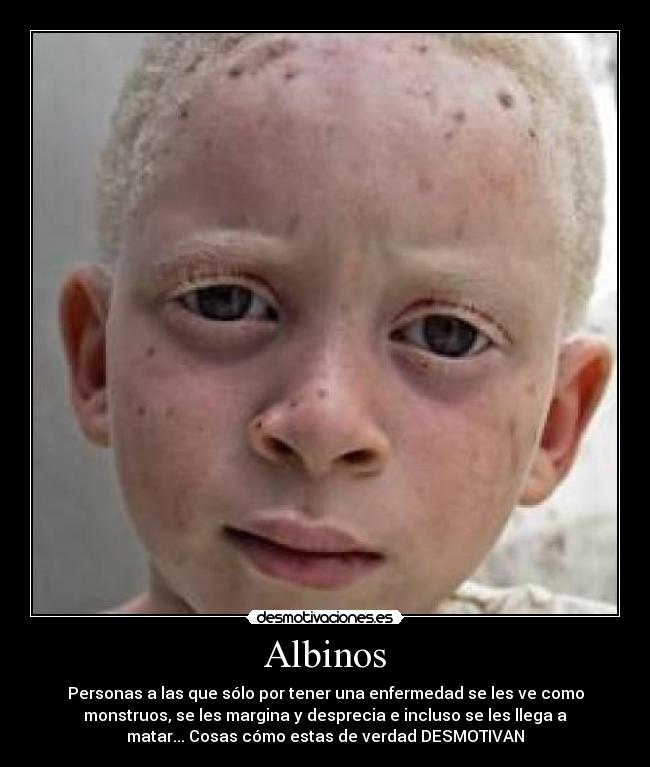 Albinos - Personas a las que sólo por tener una enfermedad se les ve como
monstruos, se les margina y desprecia e incluso se les llega a
matar... Cosas cómo estas de verdad DESMOTIVAN