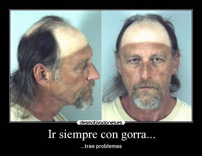 Ir siempre con gorra... - ...trae problemas