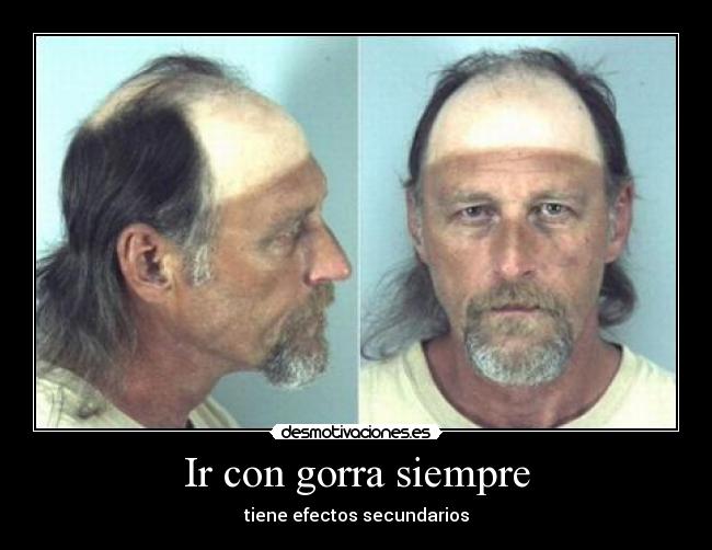 Ir con gorra siempre - tiene efectos secundarios