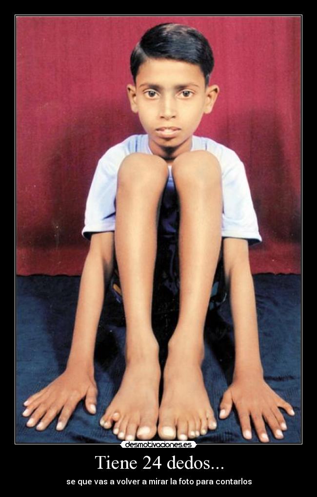 Tiene 24 dedos... -