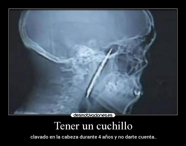 Tener un cuchillo - clavado en la cabeza durante 4 años y no darte cuenta..