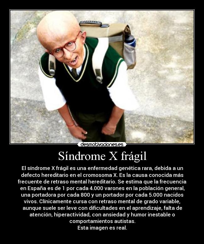 Síndrome X frágil - El síndrome X frágil es una enfermedad genética rara, debida a un
defecto hereditario en el cromosoma X. Es la causa conocida más
frecuente de retraso mental hereditario. Se estima que la frecuencia
en España es de 1 por cada 4.000 varones en la población general,
una portadora por cada 800 y un portador por cada 5.000 nacidos
vivos. Clínicamente cursa con retraso mental de grado variable,
aunque suele ser leve con dificultades en el aprendizaje, falta de
atención, hiperactividad, con ansiedad y humor inestable o
comportamientos autistas.
Esta imagen es real.
