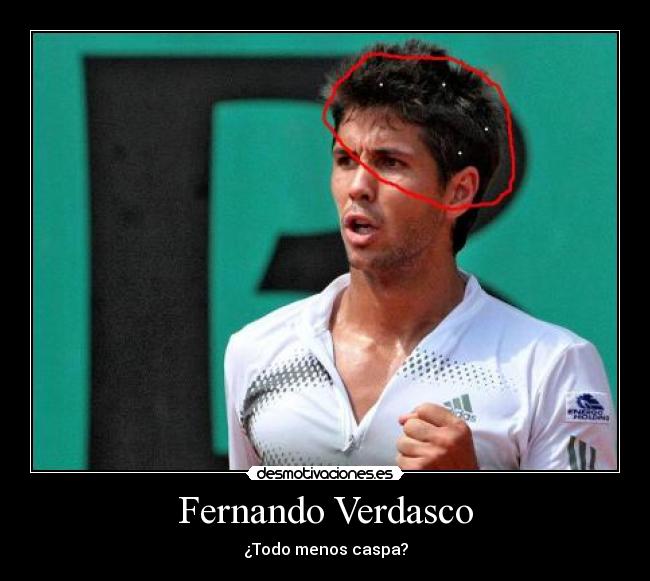 Fernando Verdasco - ¿Todo menos caspa?