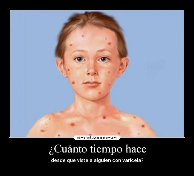 ¿Cuánto tiempo hace - desde que viste a alguien con varicela?