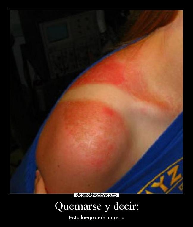 Quemarse y decir: - 