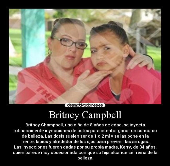 Britney Campbell - Britney Champbell, una niña de 8 años de edad, se inyecta
rutinariamente inyecciones de botox para intentar ganar un concurso
de belleza. Las dosis suelen ser de 1 o 2 ml y se las pone en la
frente, labios y alrededor de los ojos para prevenir las arrugas.
Las inyecciones fueron dadas por su propia madre, Kerry, de 34 años,
quien parece muy obsesionada con que su hija alcance ser reina de la
belleza.