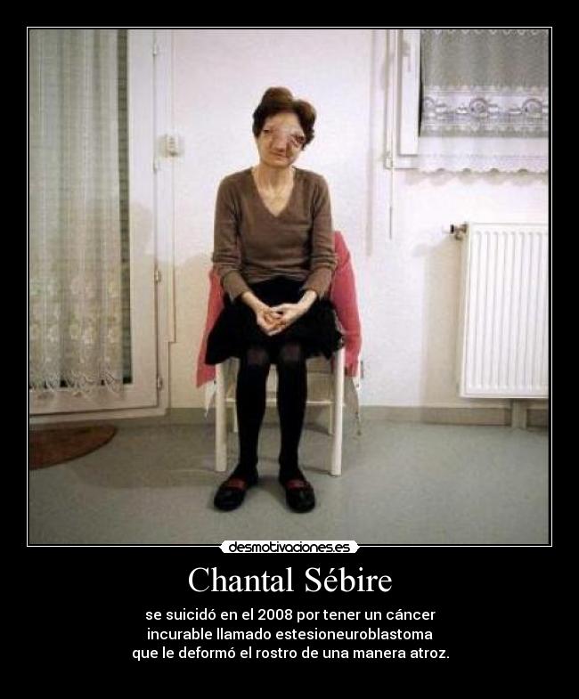 Chantal Sébire - se suicidó en el 2008 por tener un cáncer
incurable llamado estesioneuroblastoma
que le deformó el rostro de una manera atroz.