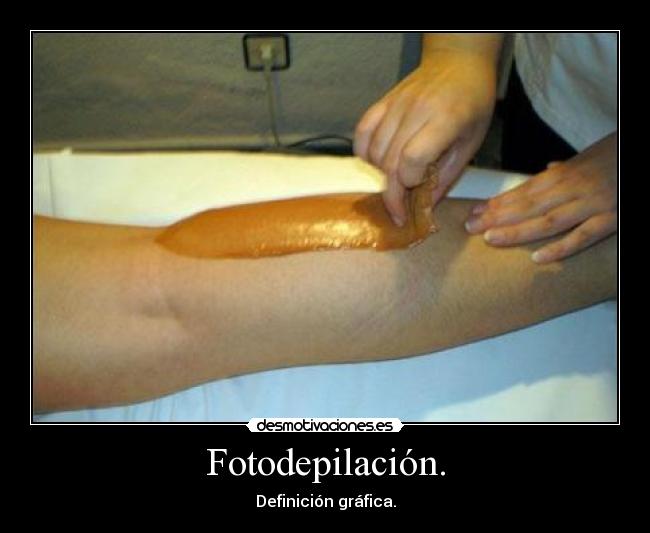 Fotodepilación. - 