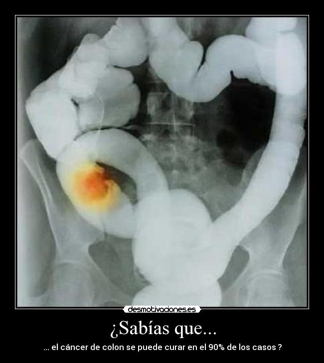 ¿Sabías que... - ... el cáncer de colon se puede curar en el 90% de los casos ?