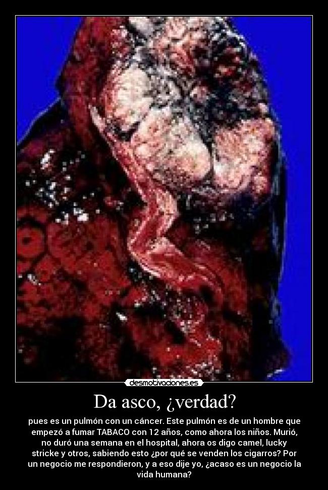 Da asco, ¿verdad? - pues es un pulmón con un cáncer. Este pulmón es de un hombre que
empezó a fumar TABACO con 12 años, como ahora los niños. Murió,
no duró una semana en el hospital, ahora os digo camel, lucky
stricke y otros, sabiendo esto ¿por qué se venden los cigarros? Por
un negocio me respondieron, y a eso dije yo, ¿acaso es un negocio la
vida humana?