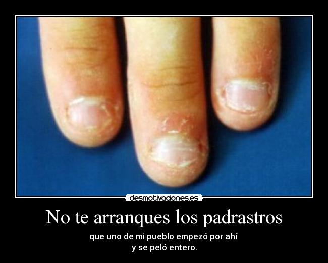 No te arranques los padrastros -