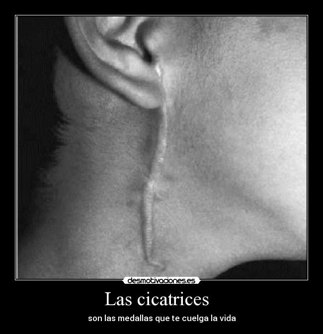 Las cicatrices   - son las medallas que te cuelga la vida