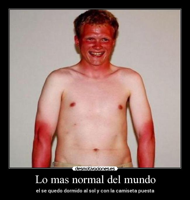 Lo mas normal del mundo - el se quedo dormido al sol y con la camiseta puesta