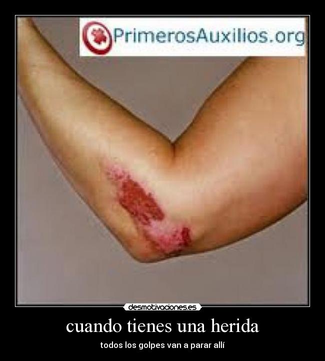cuando tienes una herida - todos los golpes van a parar allí