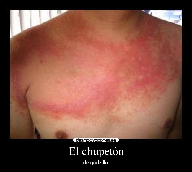 El chupetón -