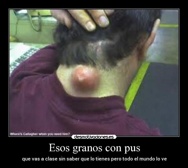 Esos granos con pus - que vas a clase sin saber que lo tienes pero todo el mundo lo ve