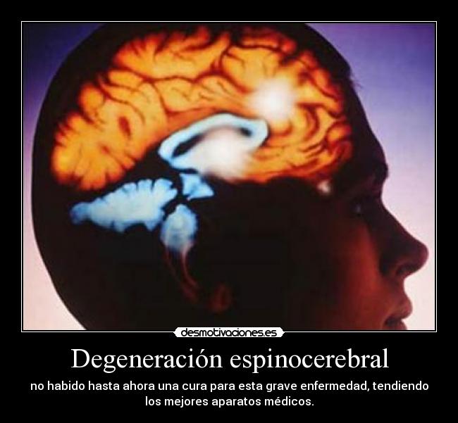 Degeneración espinocerebral - no habido hasta ahora una cura para esta grave enfermedad, tendiendo
los mejores aparatos médicos.