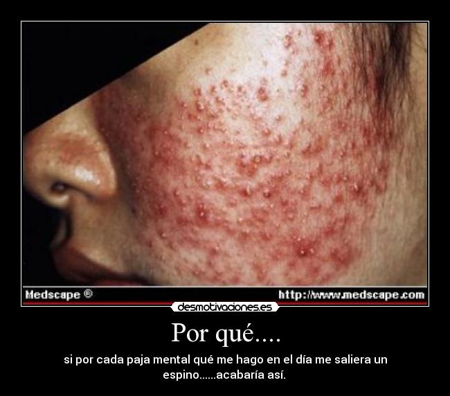 Por qué.... - si por cada paja mental qué me hago en el día me saliera un espino......acabaría así. 