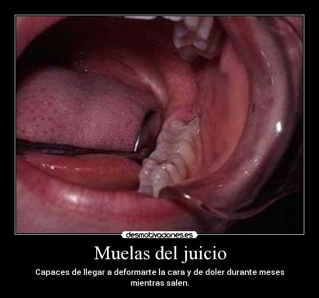 Muelas del juicio - 