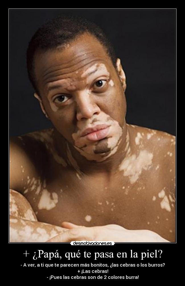 + ¿Papá, qué te pasa en la piel? - - A ver, a ti que te parecen más bonitos, ¿las cebras o los burros?
+ ¡Las cebras!
- ¡Pues las cebras son de 2 colores burra!