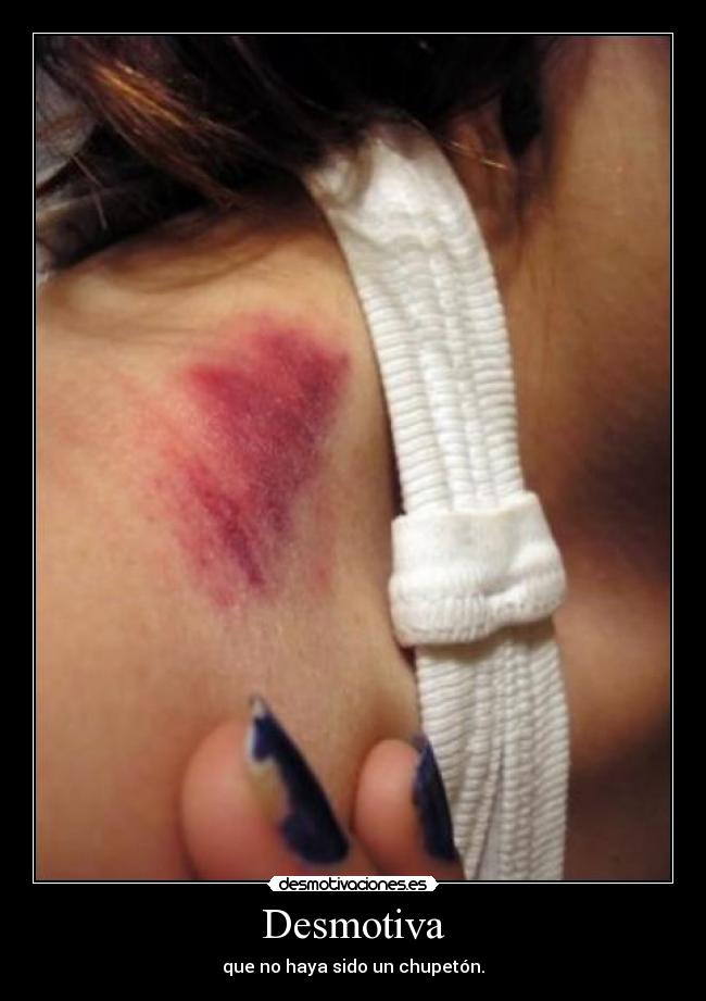 Desmotiva - que no haya sido un chupetón.