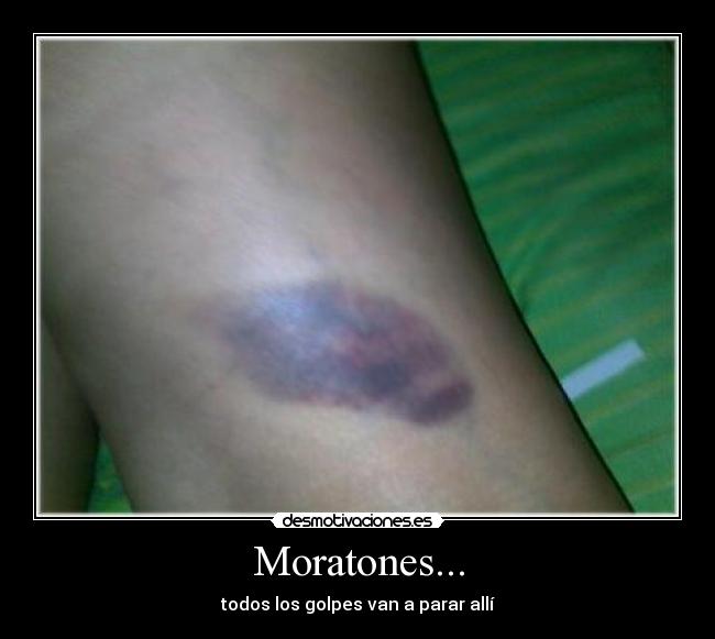 Moratones... - todos los golpes van a parar allí