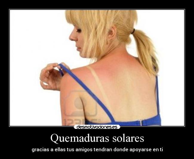 Quemaduras solares - gracias a ellas tus amigos tendran donde apoyarse en ti