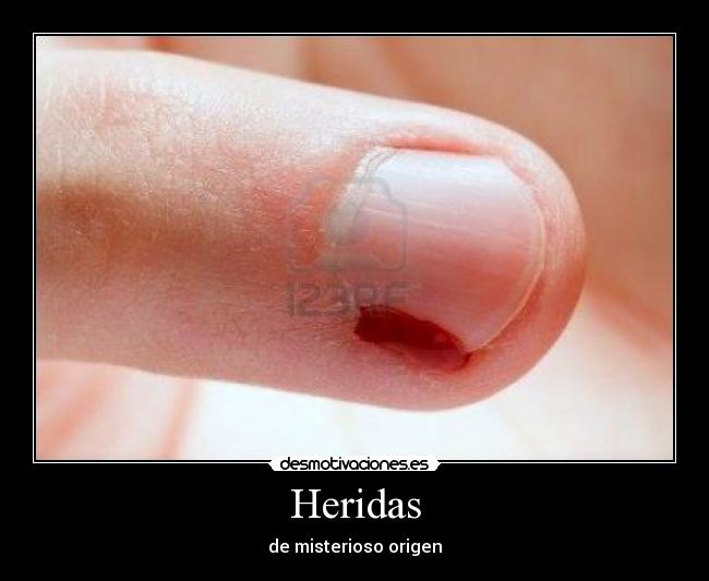 Heridas - de misterioso origen