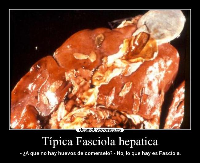Típica Fasciola hepatica -
