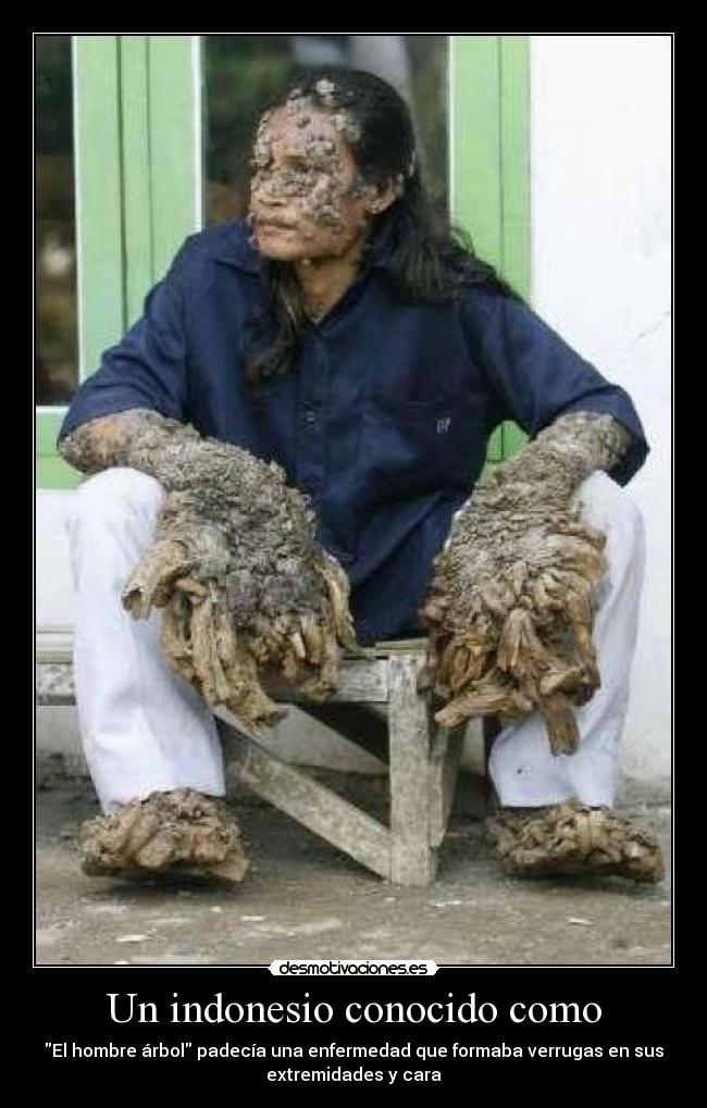 Un indonesio conocido como - El hombre árbol padecía una enfermedad que formaba verrugas en sus
extremidades y cara