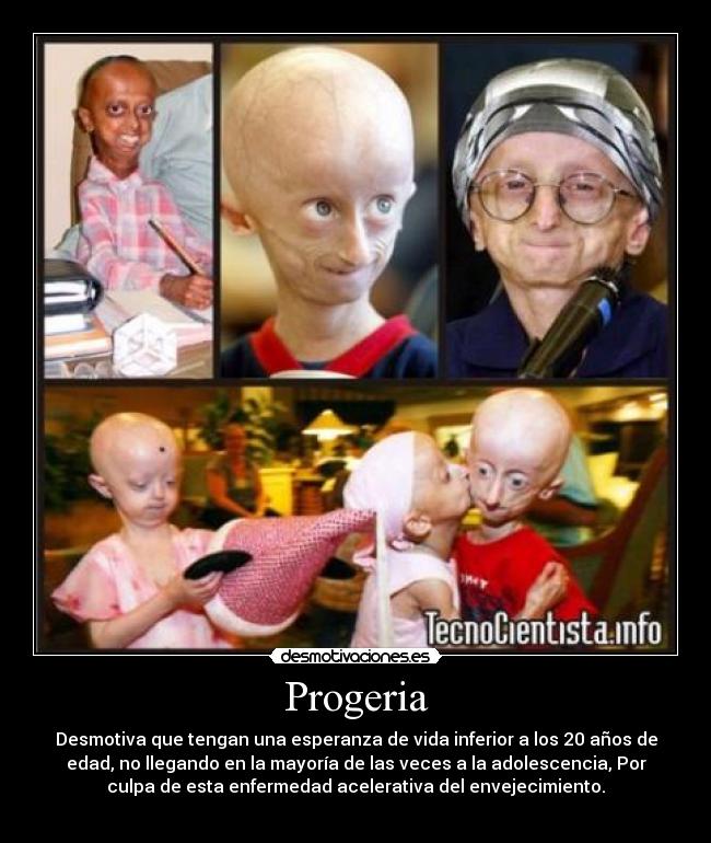 Progeria - Desmotiva que tengan una esperanza de vida inferior a los 20 años de
edad, no llegando en la mayoría de las veces a la adolescencia, Por
culpa de esta enfermedad acelerativa del envejecimiento.