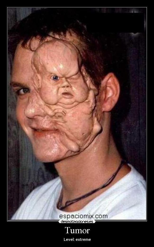 Tumor - Level: extreme