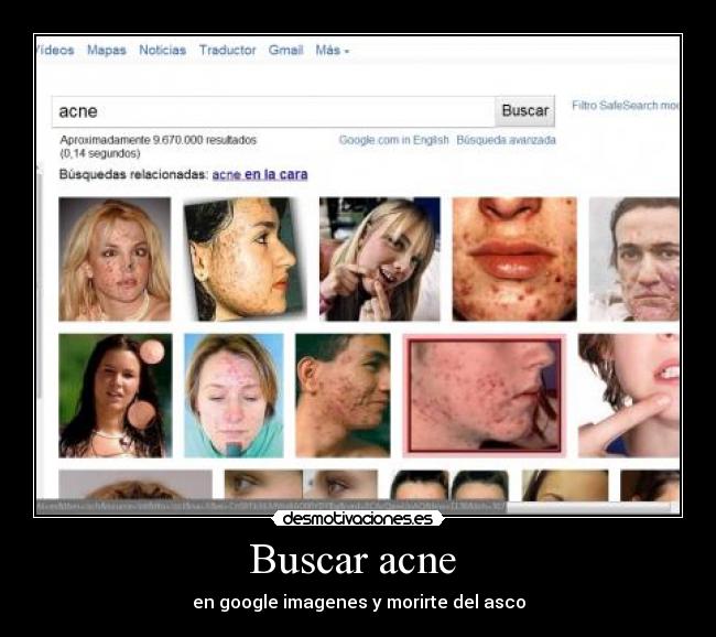 Buscar acne  - 