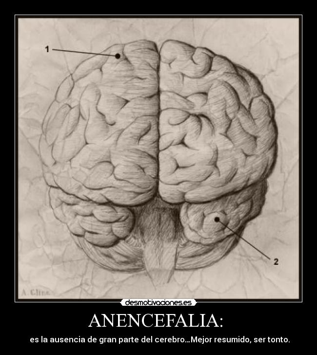 ANENCEFALIA: -