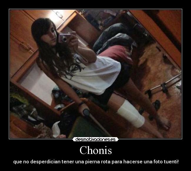 Chonis - que no desperdician tener una pierna rota para hacerse una foto tuenti!