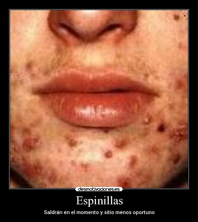 Espinillas -
