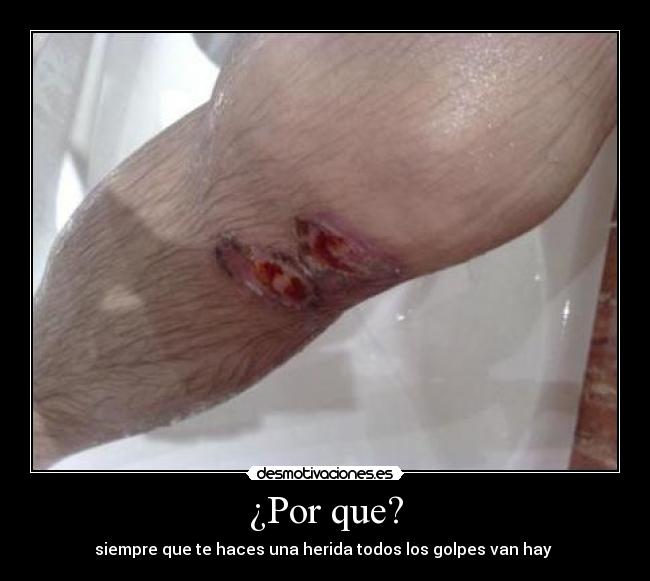 ¿Por que? - siempre que te haces una herida todos los golpes van hay