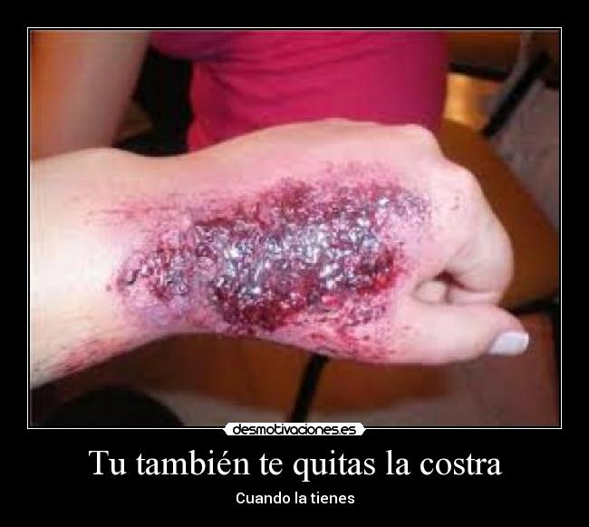 Tu también te quitas la costra - Cuando la tienes