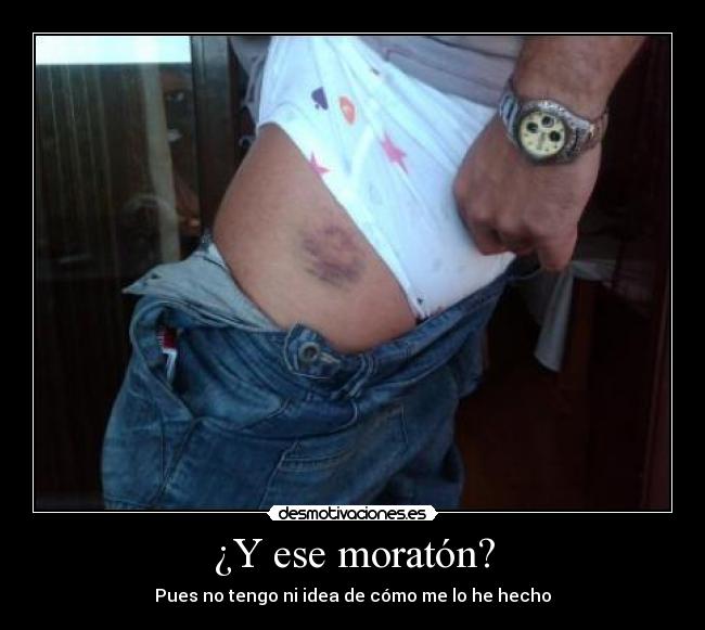 ¿Y ese moratón? -