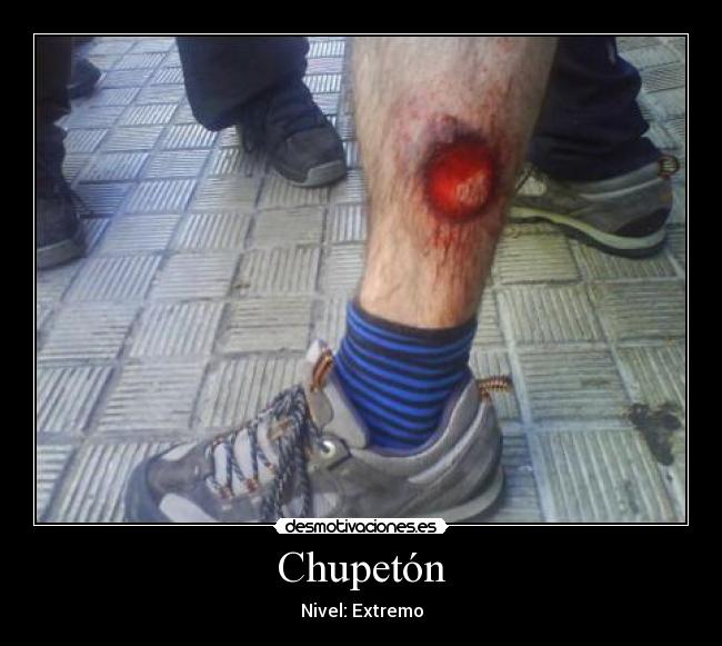Chupetón -