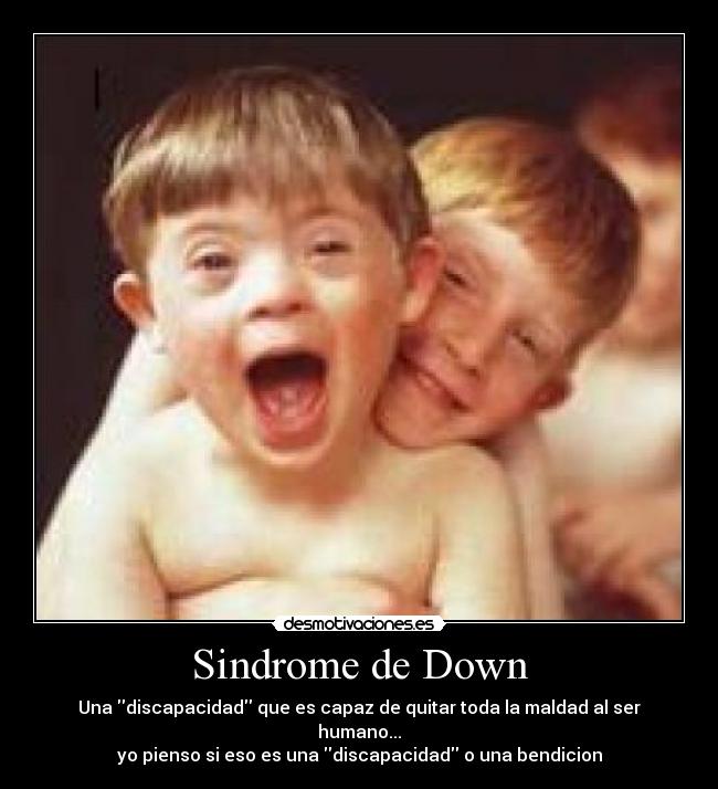 Sindrome de Down - 