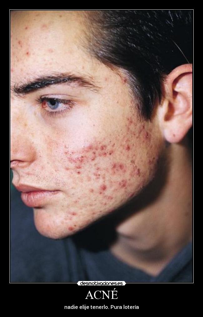 ACNÉ -