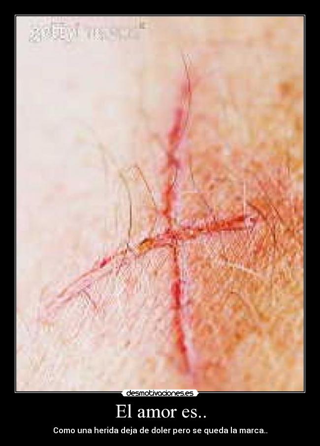 El amor es.. - Como una herida deja de doler pero se queda la marca..