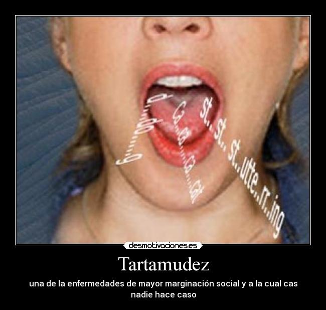Tartamudez - 
