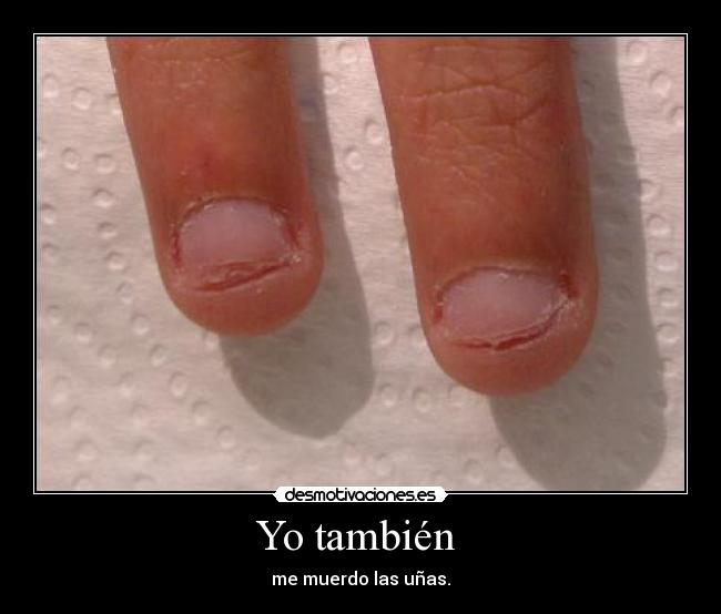 Yo también - me muerdo las uñas.