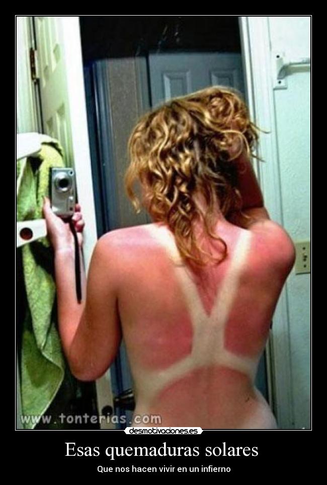 Esas quemaduras solares - Que nos hacen vivir en un infierno
