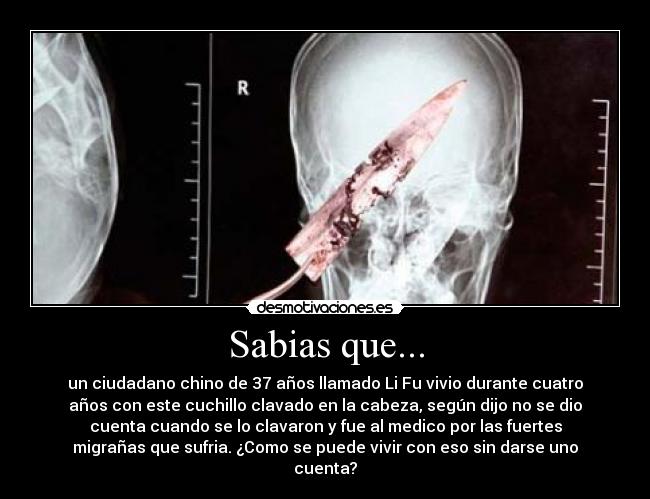 Sabias que... - un ciudadano chino de 37 años llamado Li Fu vivio durante cuatro
años con este cuchillo clavado en la cabeza, según dijo no se dio
cuenta cuando se lo clavaron y fue al medico por las fuertes
migrañas que sufria. ¿Como se puede vivir con eso sin darse uno
cuenta?