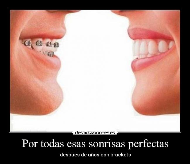 Por todas esas sonrisas perfectas - despues de años con brackets